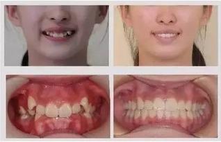 成人能牙齿再生吗视频,探索再生科技新篇章