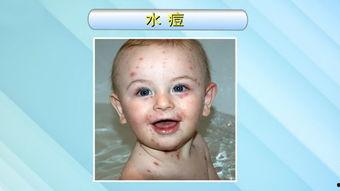 成人水痘科普视频,预防与应对科普视频精华