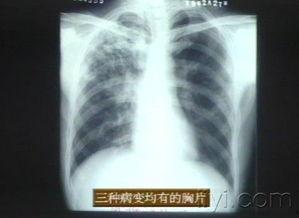 成人肺部保养方法视频讲解,跟随视频学习成人呼吸健康之道