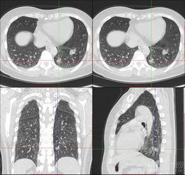 成人肺部保养方法视频讲解,跟随视频学习成人呼吸健康之道