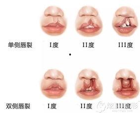 成人唇腭裂修补视频大全  第2张